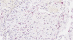 MMP9 Human lung cancer FFPE tissue